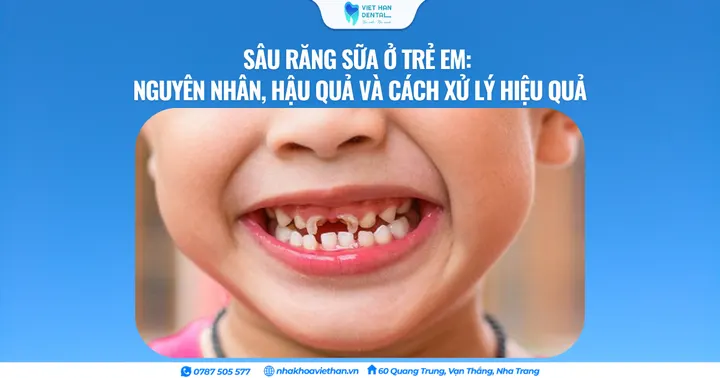 Sâu răng sữa ở trẻ em: Nguyên nhân, hậu quả và cách xử lý hiệu quả
