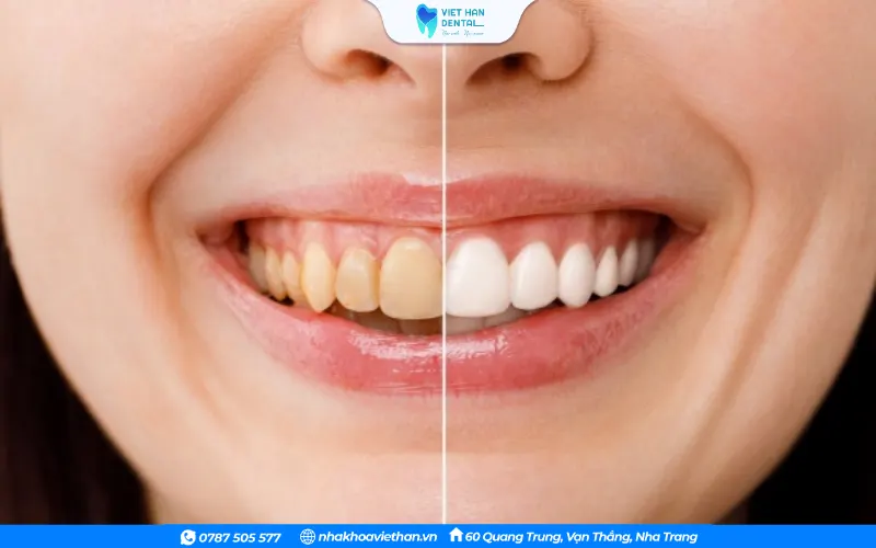 Dán sứ thẩm mỹ Veneer có thể khắc phục được tình trạng răng nhiễm màu