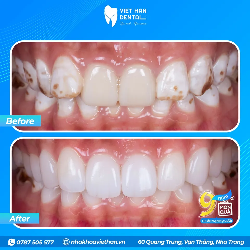 A perfect, natural-looking transformation of your teeth.