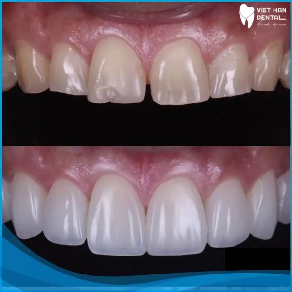 Hình ảnh trước và sau quá trình điều trị