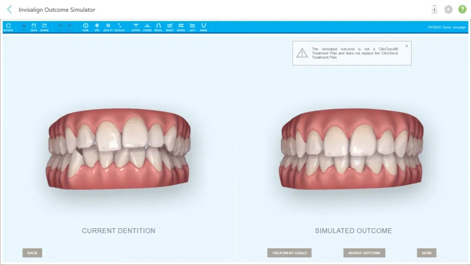 Mô tả Invisalign Outcome Simulator
