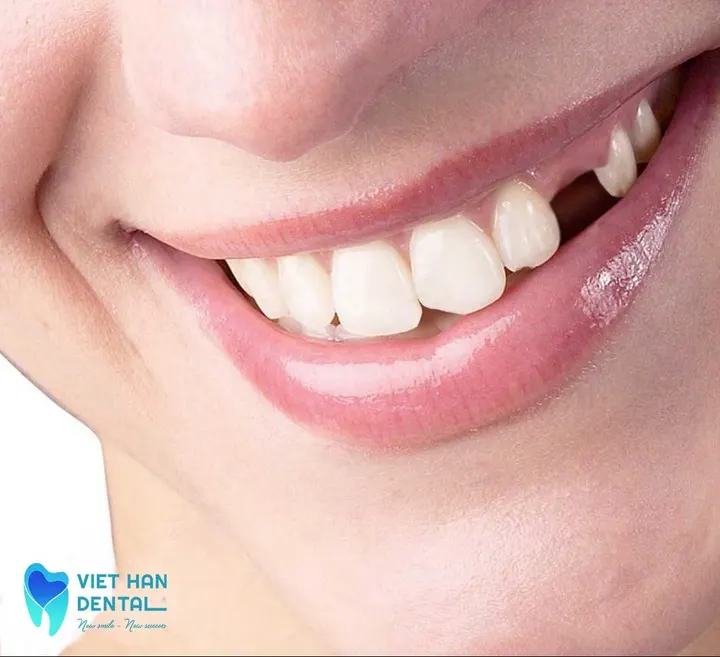 Mất răng có ảnh hưởng gì không? Giải pháp cho tình trạng mất răng