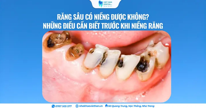 Răng sâu có niềng được không? Những điều cần biết trước khi niềng răng