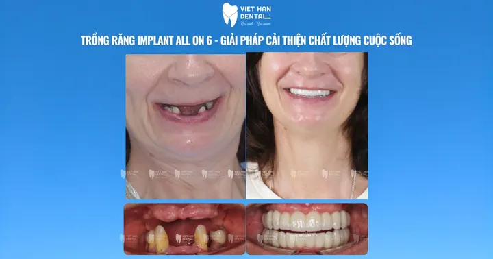 Trồng răng Implant All On 6 – Giải pháp cải thiện chất lượng cuộc sống