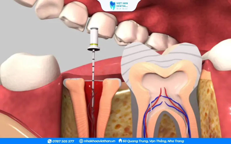 Điều trị tủy tránh tình trạng răng bị sưng viêm