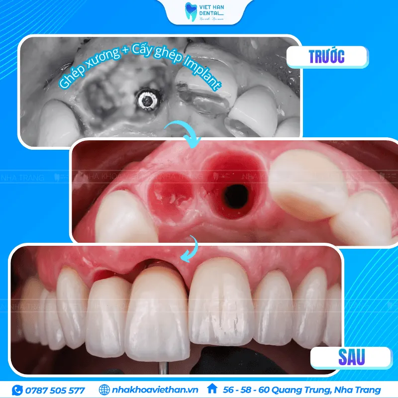 Trồng răng Implant khôi phục răng của đã mất