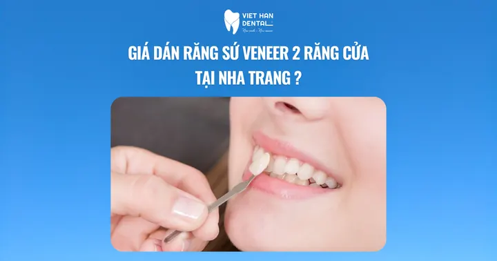 Giá dán răng sứ veneer 2 răng cửa tại Nha Trang? 