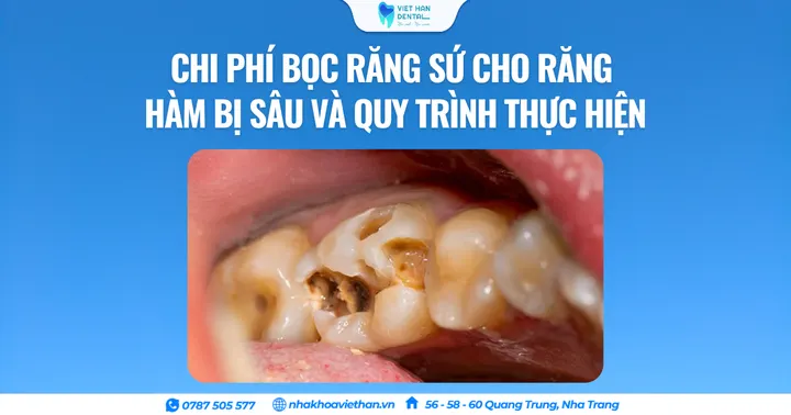 Chi phí bọc răng sứ cho răng hàm bị sâu và quy trình thực hiện
