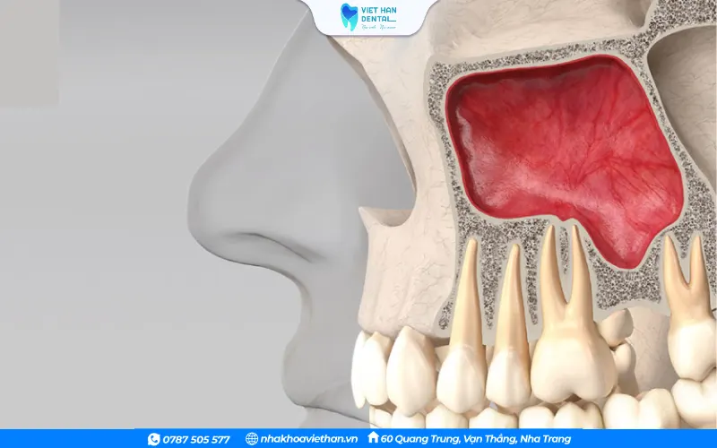 Nâng xoang hở được áp dụng khi cần tăng chiều cao xương đáng kể