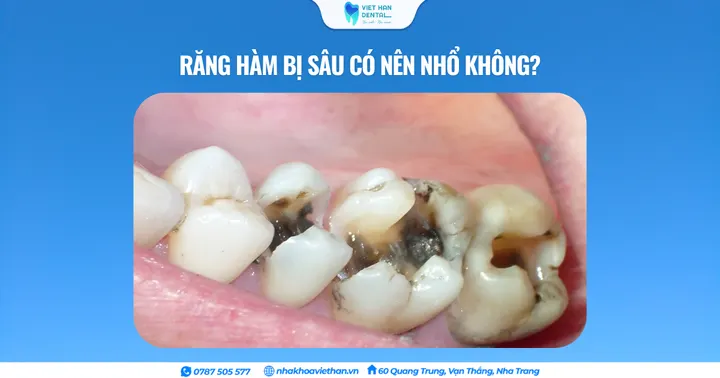 Răng hàm bị sâu có nên nhổ không?