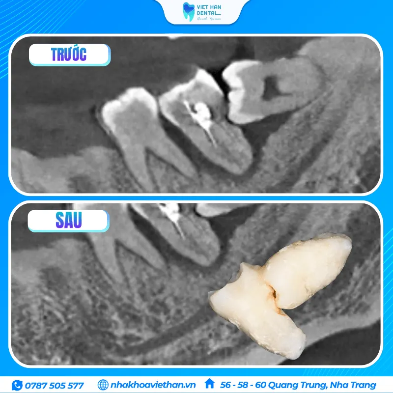 Răng khôn mọc lệch đâm vào răng số 7