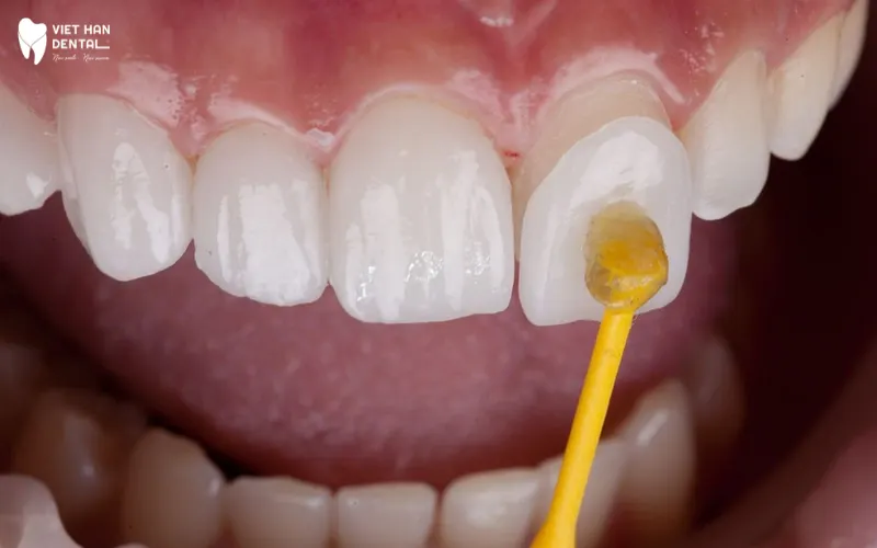 Dán sứ Veneer