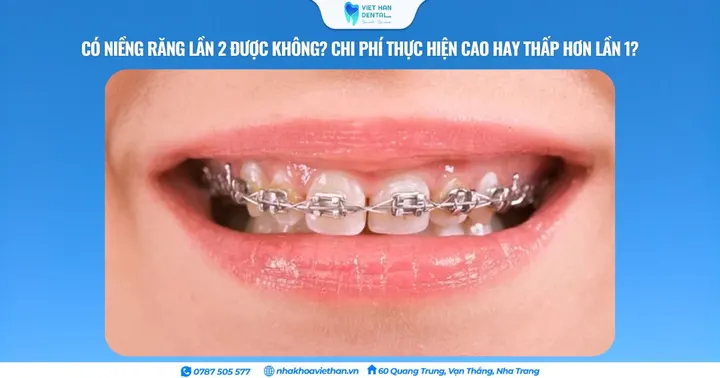 Có niềng răng lần 2 được không? Chi phí thực hiện cao hay thấp hơn lần 1?