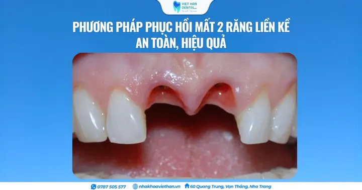 Phương pháp phục hồi mất 2 răng liền kề an toàn, hiệu quả