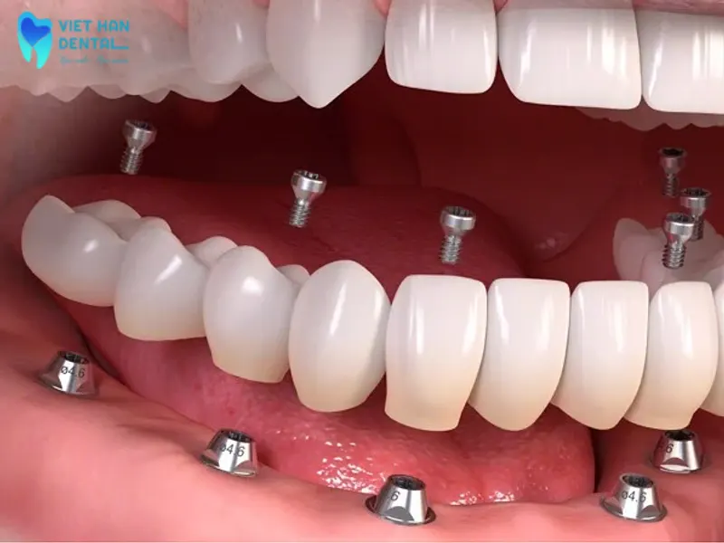 Cấy implant toàn hàm