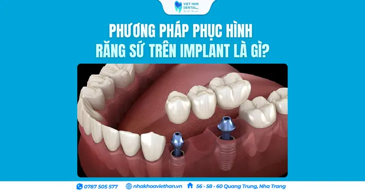 Phương pháp phục hình răng sứ trên Implant là gì?