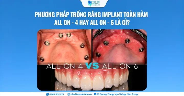 Phương pháp trồng răng Implant toàn hàm All on – 4 hay All on – 6 là gì?