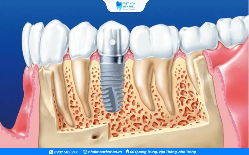 Tình trạng xương đảm bảo tốt mới có thể thực hiện trồng răng Implant