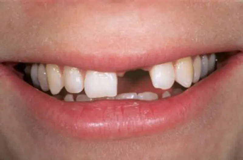 Tình trạng mất răng cửa
