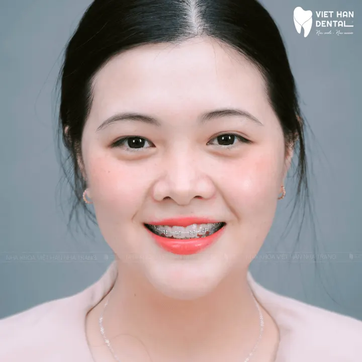 Nhờ niềng răng cô sinh viên “lột xác” nụ cười và tự tin tận hưởng 4 năm đại học tuyệt vời