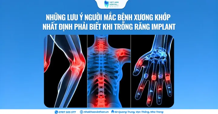 Những lưu ý người mắc bệnh xương khớp nhất định phải biết khi trồng răng Implant