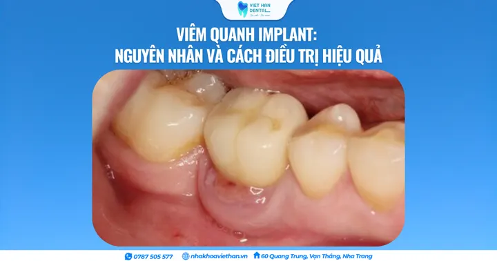 Viêm quanh Implant: Nguyên nhân và cách điều trị hiệu quả