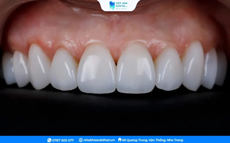 Răng sứ có màu sắc tự nhiên, hòa hợp với hàm răng thật