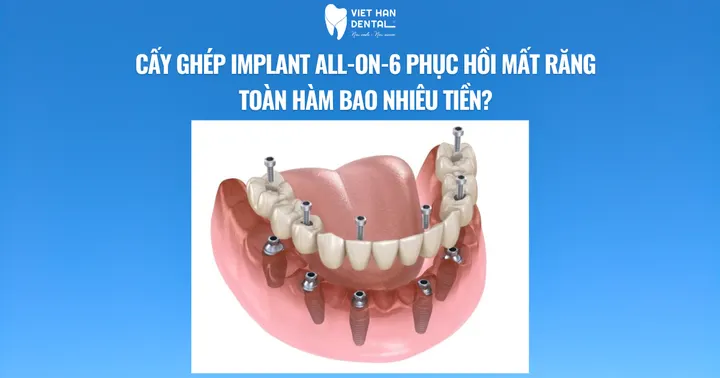 Cấy ghép Implant All-On-6 phục hồi mất răng toàn hàm bao nhiêu tiền?