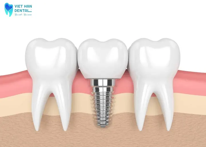 Lịch sử hình thành phương pháp trồng răng Implant