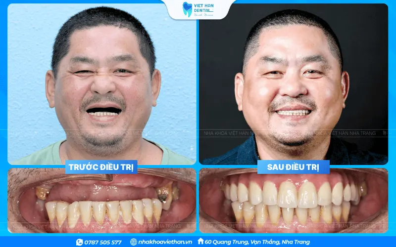 Khách Hàng Bọc Sứ (1)