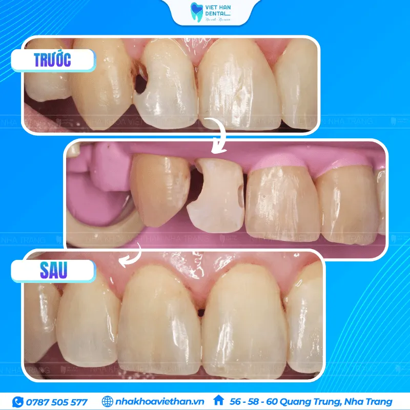 Trám sâu kẽ răng cửa số 2