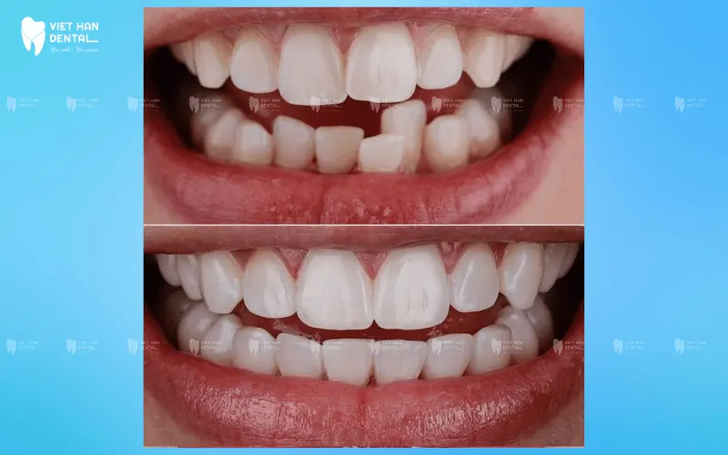Khách hàng niềng răng Invisalign tại Nha khoa Việt Hàn