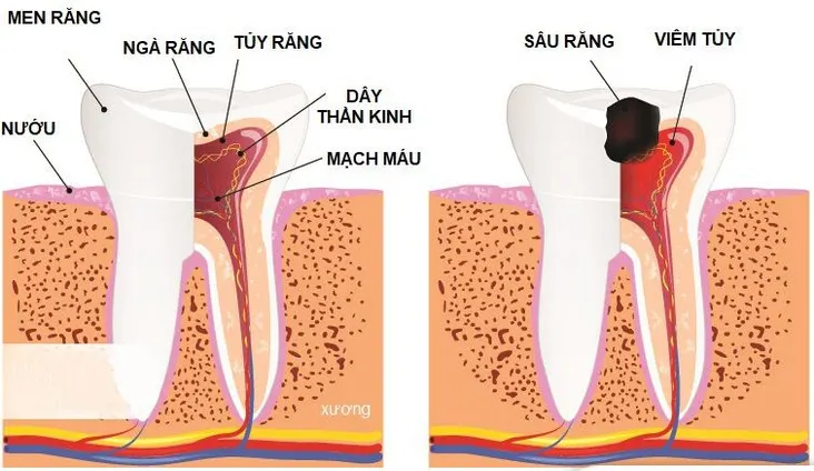 viem-tuy-rang-nguyen-nhan-trieu-chung-va-cach-phong-ngua