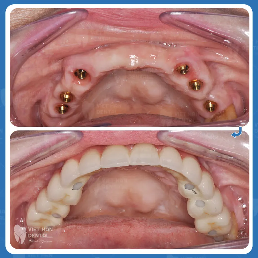 Cắm rnawg Implant phục hồi răng đã mất