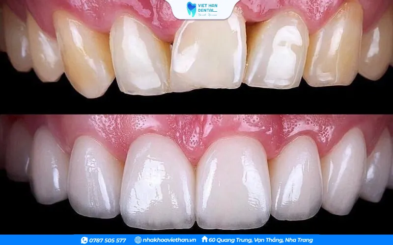 Trước và sau khi làm răng sứ