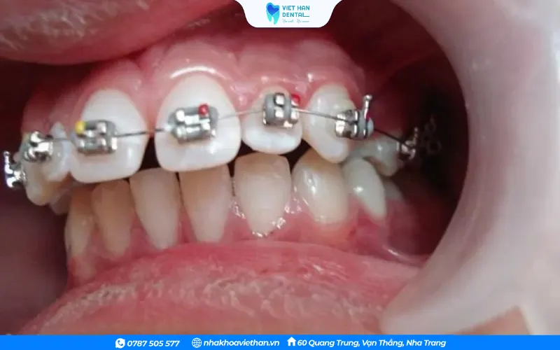 Niềng răng mắc cài hàm trên cho trường hợp răng bị hô và thưa