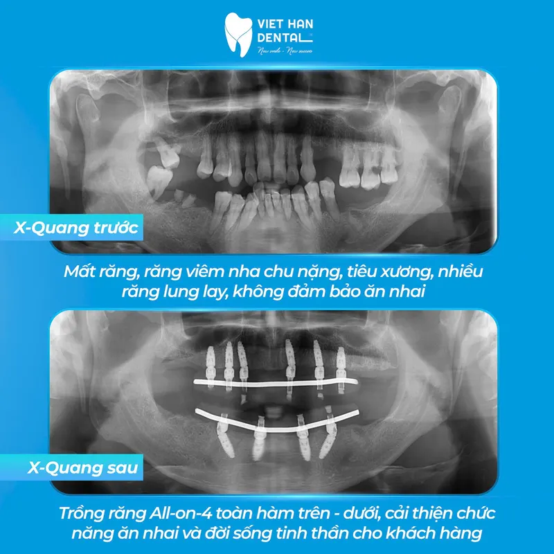 Trước Và Sau Implant