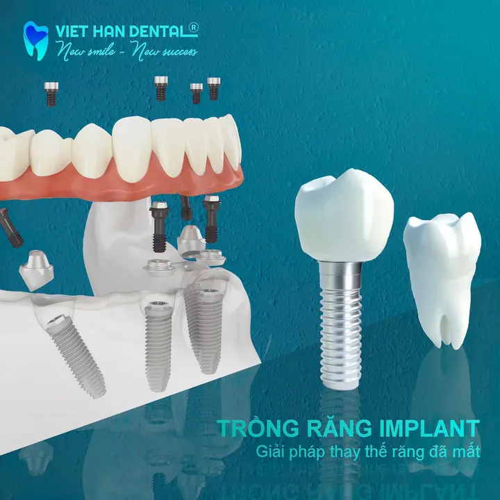 Ưu đãi trồng răng implant Nha Trang tháng 3/2023