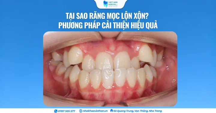 Tại sao răng mọc lộn xộn? Phương pháp cải thiện hiệu quả