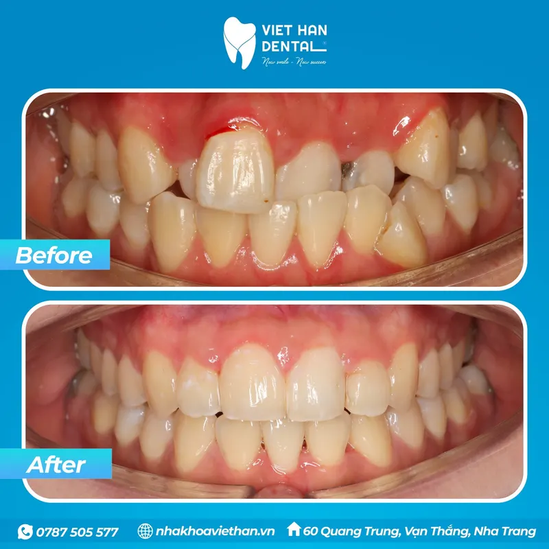 Hình ảnh răng của khách hàng trước và sau khi niềng răng tại Nha khoa Việt Hàn