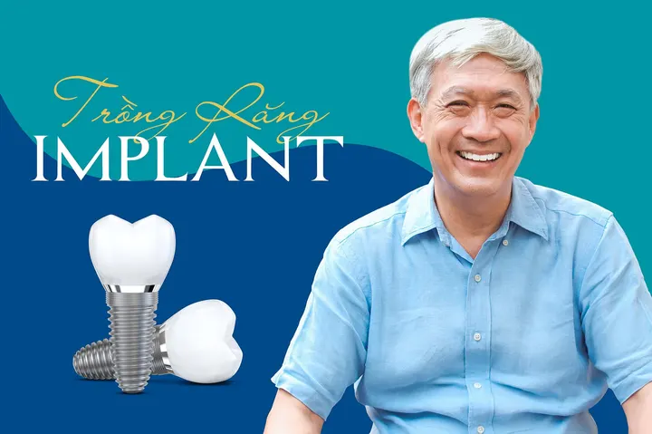 Trồng Răng Implant