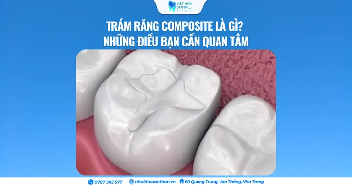 Trám răng Composite là gì? Những điều bạn cần quan tâm