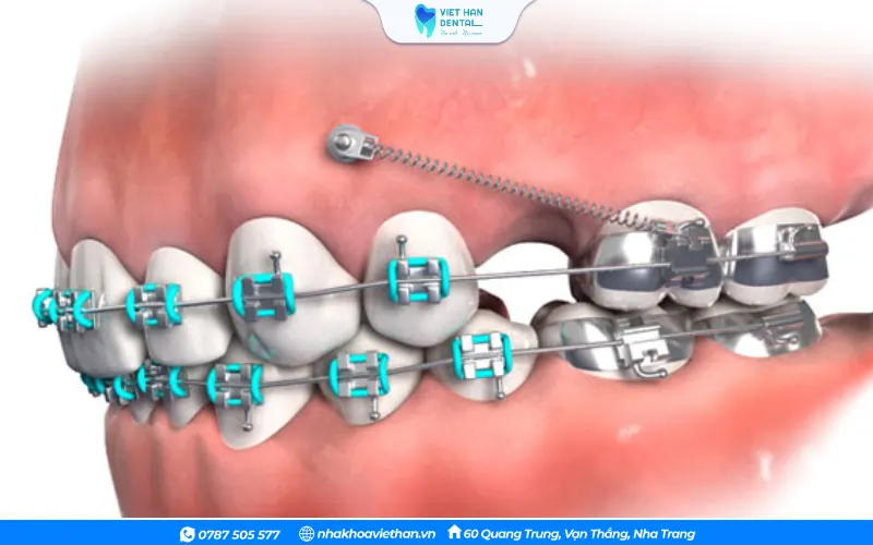 Mô phỏng kỹ thuật đánh lún răng