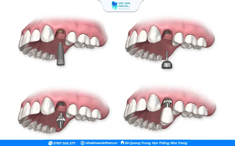 Cấy ghép Implant chịu lực tức thì