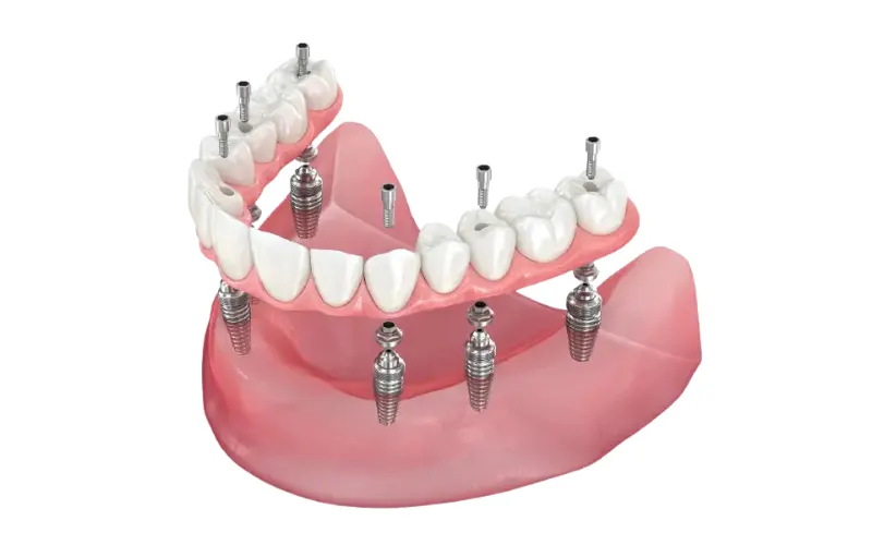 All-on-6 implants restore chewing function comparable to natural teeth
