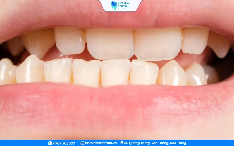 Hàm dưới phát triển quá mức hoặc hàm trên kém phát triển dẫn đến lệch khớp cắn