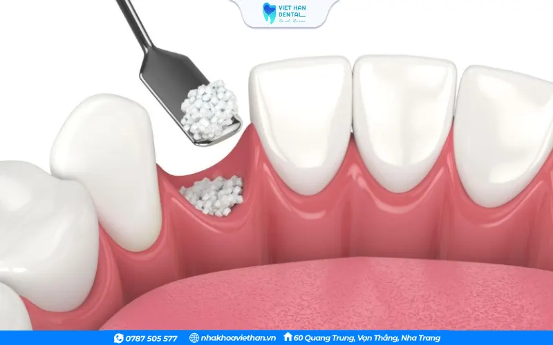 Sử dụng xương nhân tạo trong trường hợp không thể sử dụng các loại xương khác