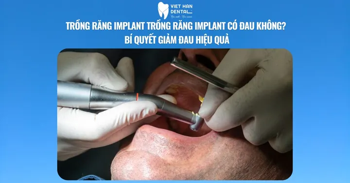 Trồng răng Implant có đau không? Bí quyết giảm đau hiệu quả