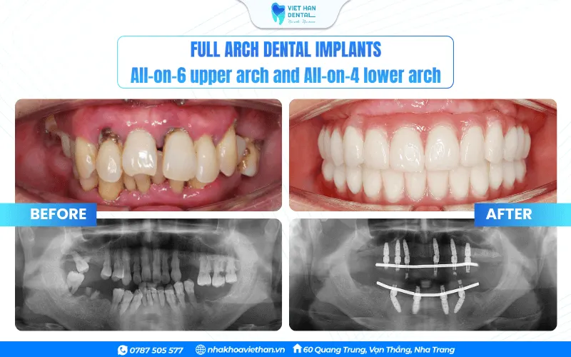 Patients before and after dental implant treatment at Viet Han Dental Clinic.