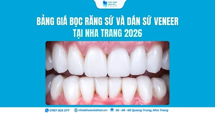Bảng giá bọc răng sứ và dán sứ Veneer tại Nha Trang 2026